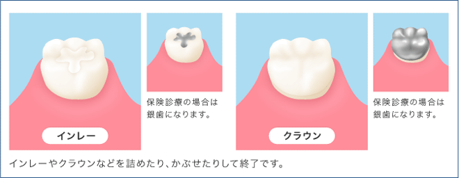 インレー・クラウン