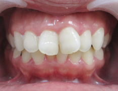 Before