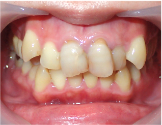 Before