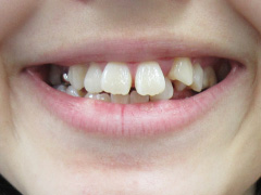 Before