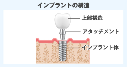 インプラント・アタッチメント・上部構造の3つ