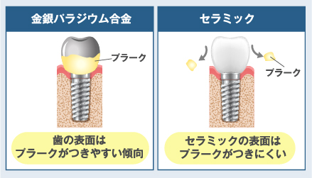 衛生面 セラミックの表面はプラークがつきにくい