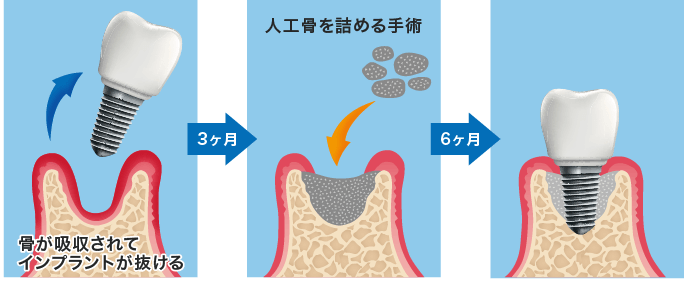 抜けてしまったら