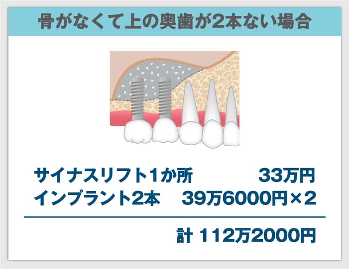 骨がなくて上の奥歯が2本ない場合