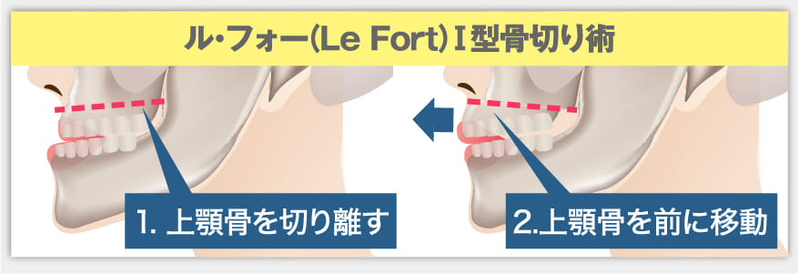 顎矯正手術