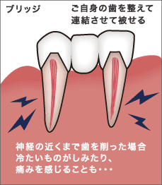 神経の近くまで歯を削った場合冷たいものがしみたり、痛みを感じることも&hellip;