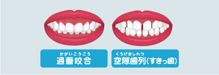 不正咬合の種類について
