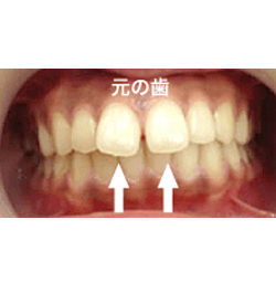 差し歯について