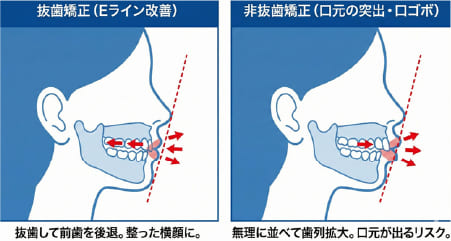 抜歯矯正と非抜歯矯正による口元の突出感（Eライン）の変化イメージ比較図
