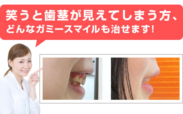笑うと歯茎が見えてしまう方、改善できます!