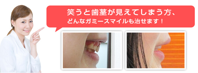 笑うと歯茎が見えてしまう方、改善できます!