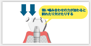 セラミッククラウンの破損