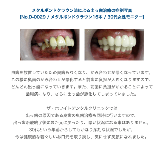 セラミッククラウン法による出っ歯治療の症例写真