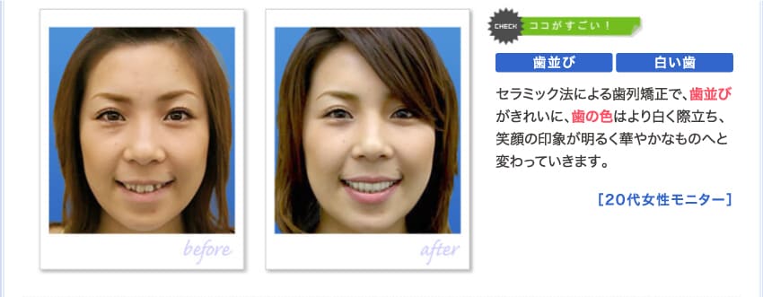 セラミック法による歯列矯正で、歯並びがきれいに、歯の色はより白く際立ち、笑顔の印象が明るく華やかなものへと変わっています。