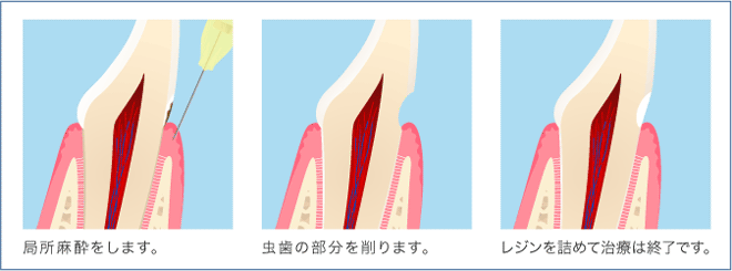 小さい虫歯の工程