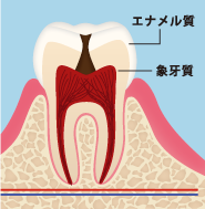 神経まで達している