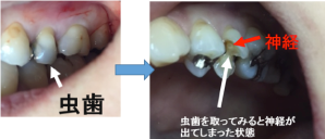 仮性露髄