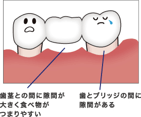 歯とのすき間