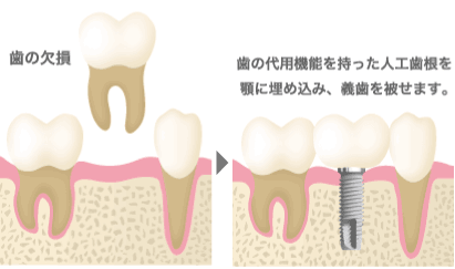 歯の欠損