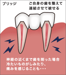 ご自身の歯を整えて連結させて被せる