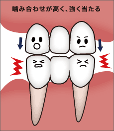 噛み合わせが高い
