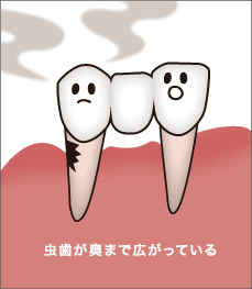 虫歯が奥まで広がる