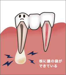 歯の根に膿の袋ができている場合