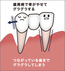 歯周病で骨が痩せてグラグラする