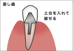 差し歯
