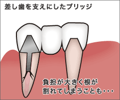 差し歯を支えに