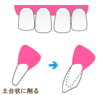 歯型をとる