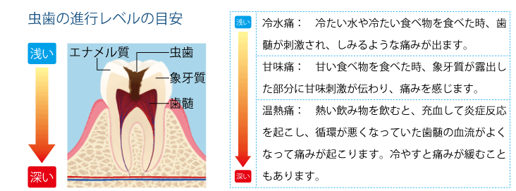 虫歯の進行レベルの目安