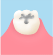 セラミックインレー