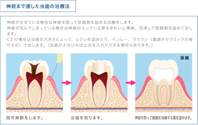 神経まで達した虫歯の治療