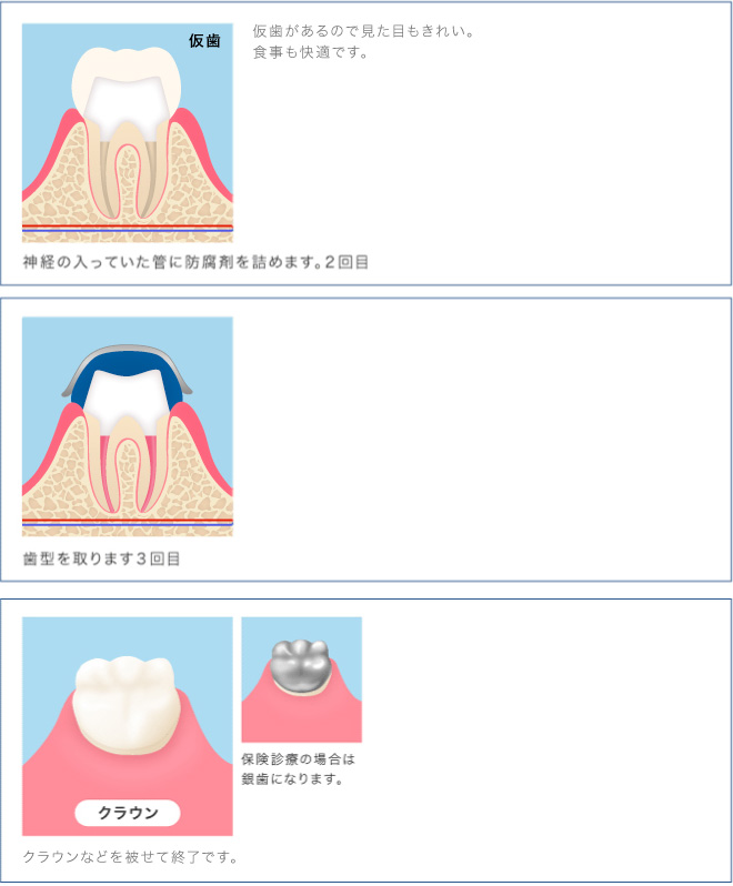 仮歯
