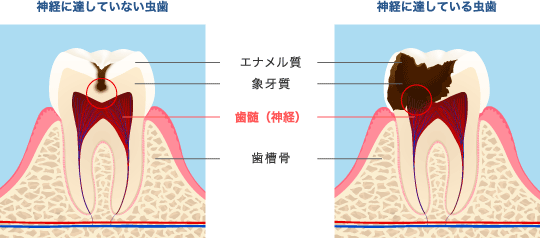 虫歯の進行
