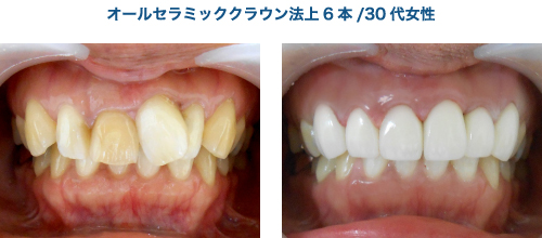 セラミッククラウン法