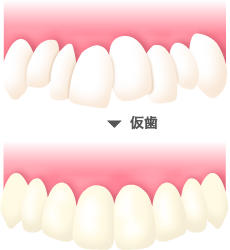 歯を削る