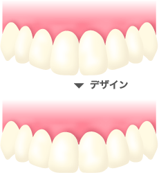 仮歯の形をデザイン