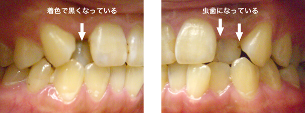歯を削る