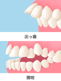 出っ歯の状態