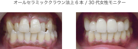 セラミック症例