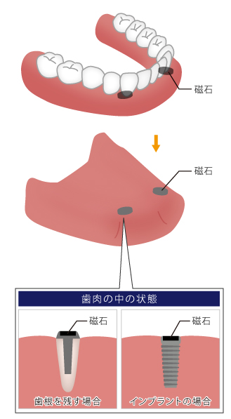歯肉の中の状態