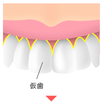 仮歯を装着