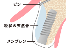 骨に置換される人工骨