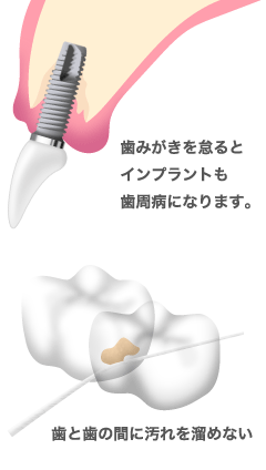 インプラントも歯周病になる