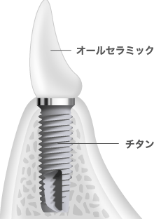オールセラミック