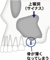 サイナスリフト1