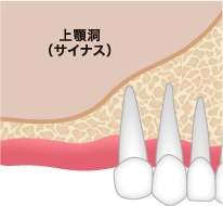 サイナスリフト2