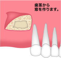 サイナスリフト3
